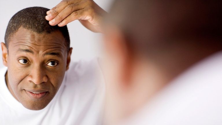 My Relationship Is Ruined Due to Baldness. What Should I Do?